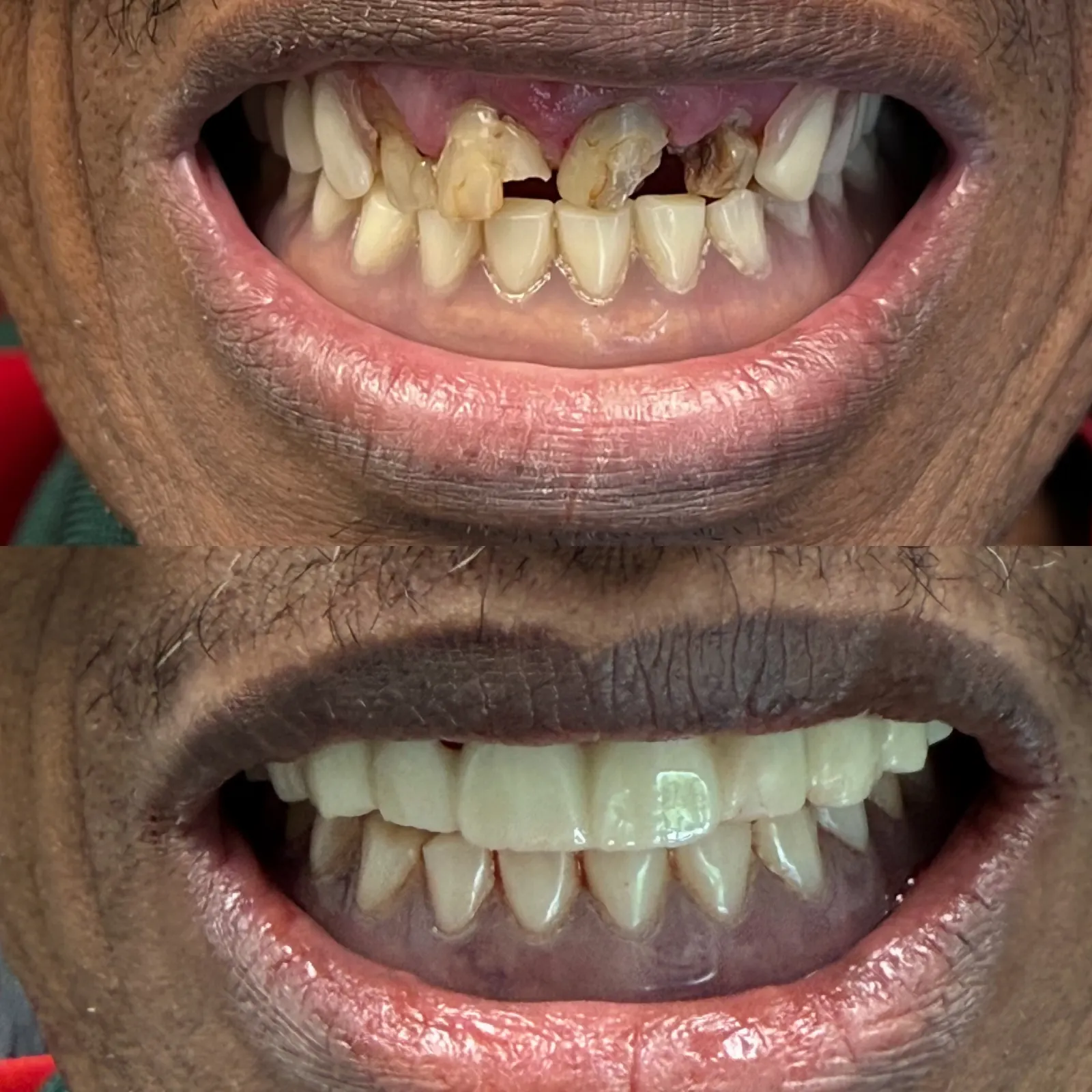 After All-on-4: a completed full-arch implant bridge restoring a natural-looking smile