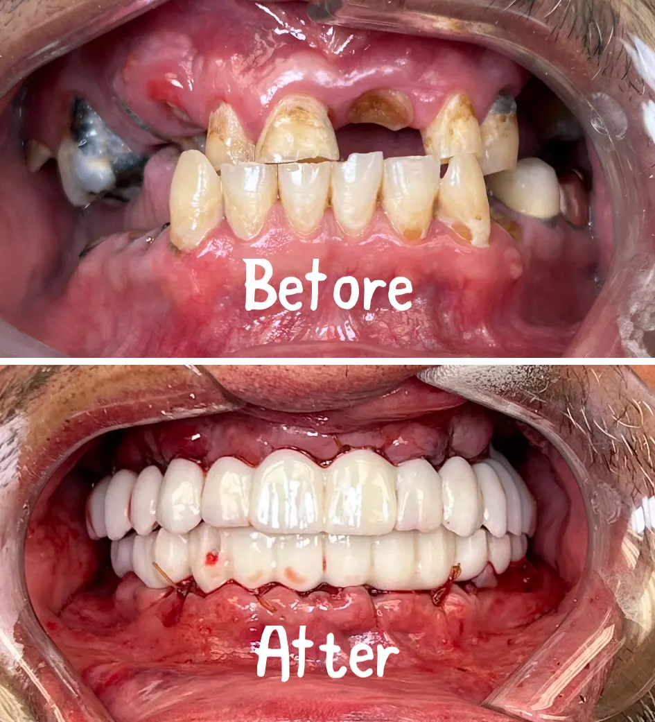 Before All-on-4: a West Covina patient's failing upper arch with advanced decay and broken teeth