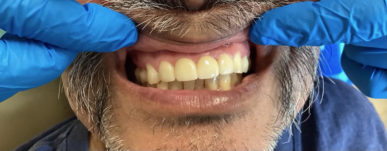 After - Cosmetic Dentistry