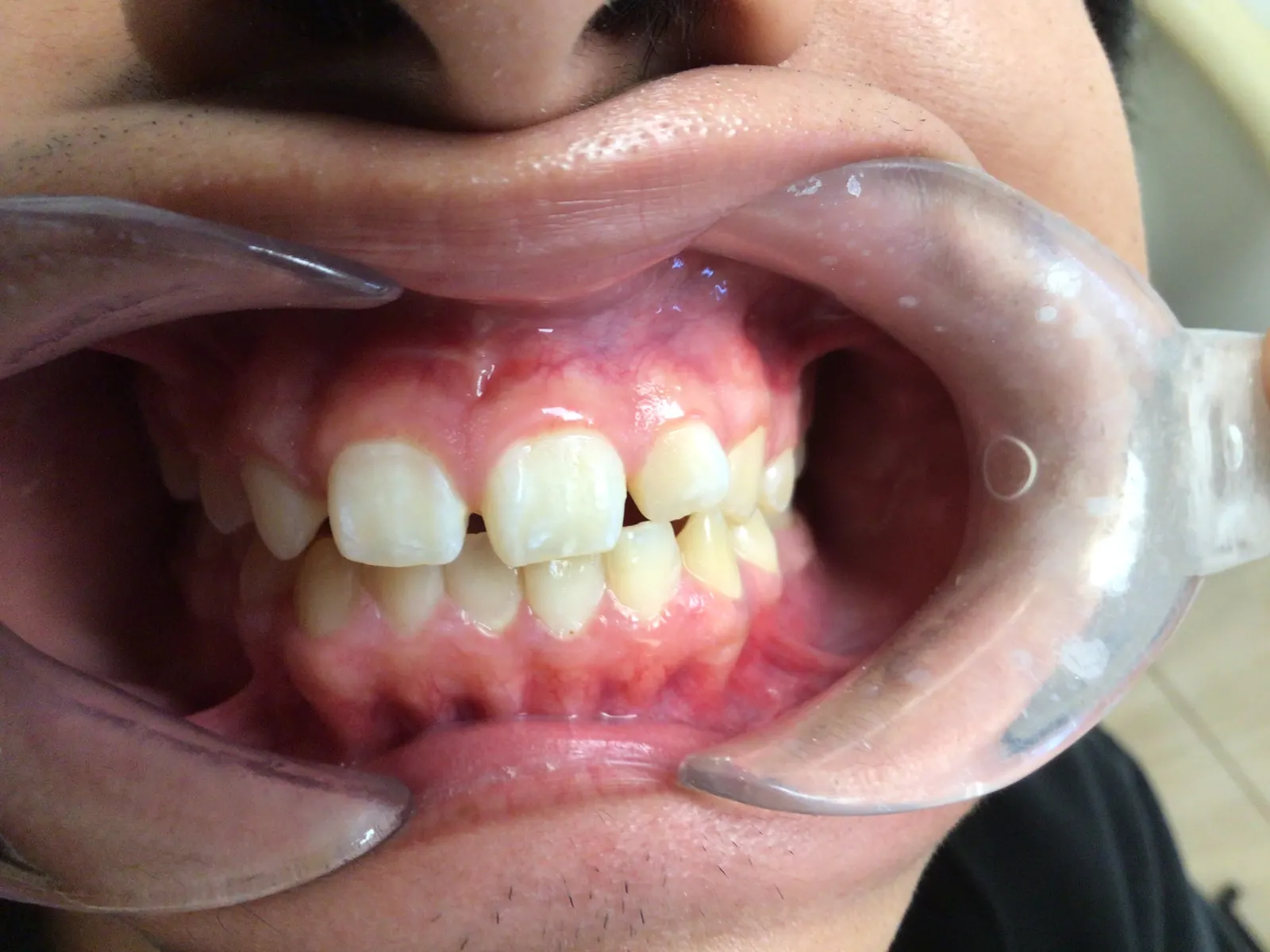 Before - Cosmetic Dentistry