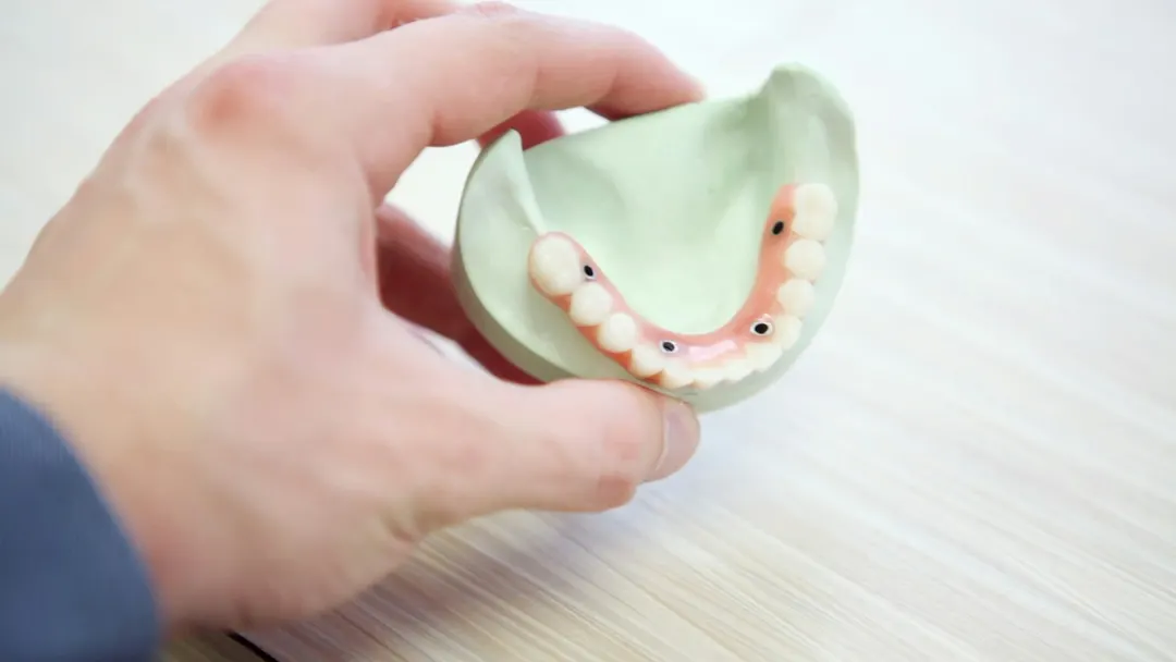 Full-arch implant-supported denture held in hand, showing the implant attachment sites used in All-on-4 treatment