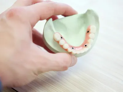 Full-arch implant-supported denture held in hand, showing the implant attachment sites used in All-on-4 treatment