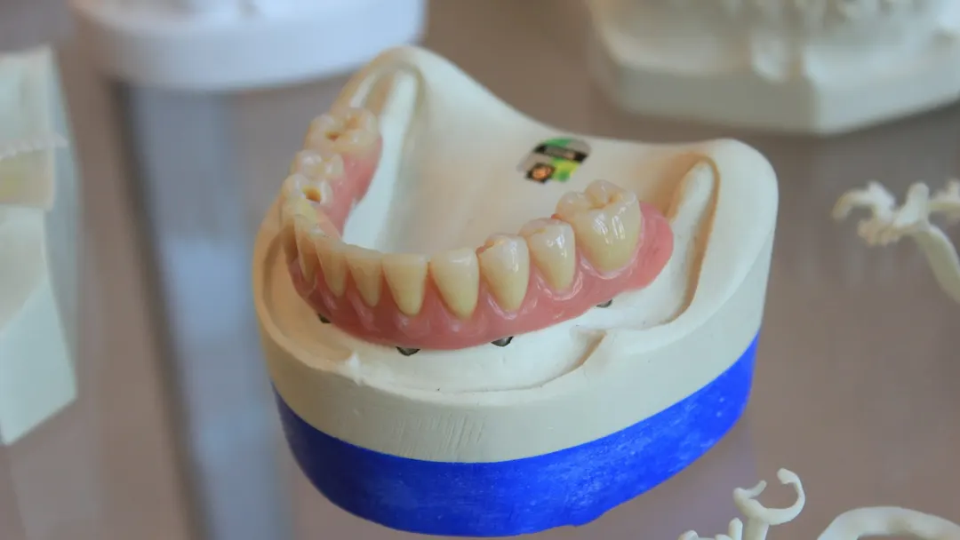 Full-arch implant-supported prosthesis on a dental lab model