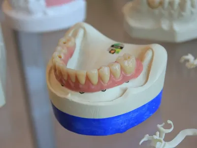 Full-arch implant-supported prosthesis on a dental lab model
