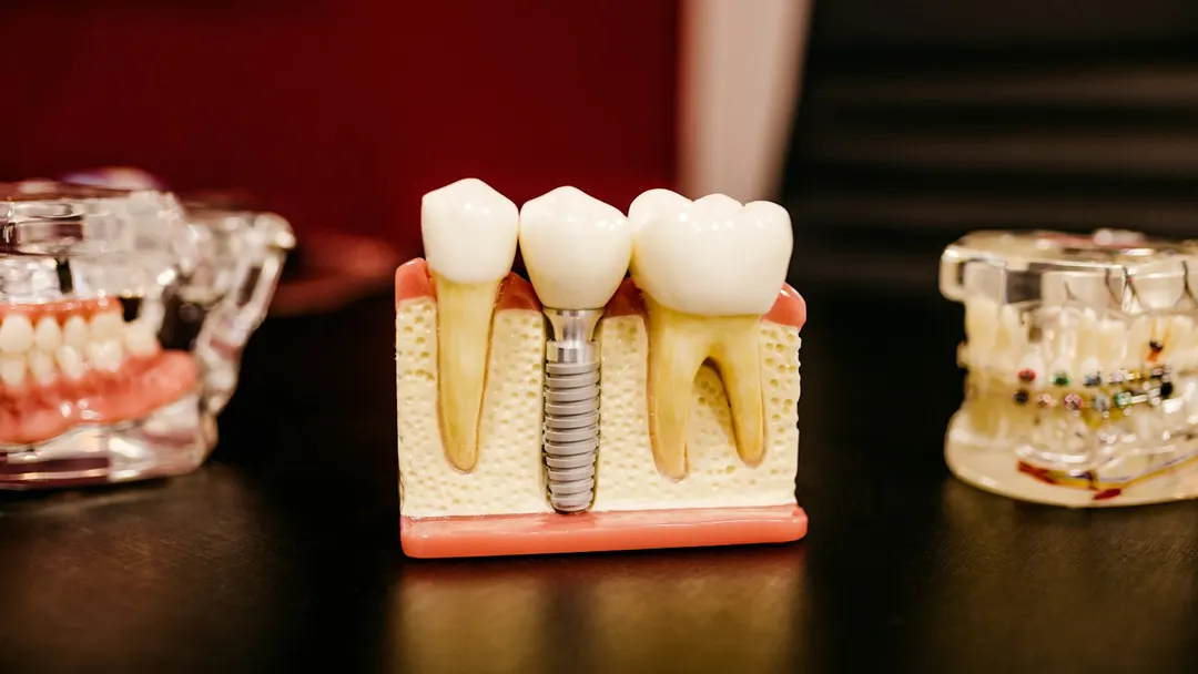 Cutaway dental implant model showing the titanium post anchored in the jawbone beneath a crown