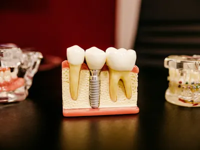 Cutaway dental implant model showing the titanium post anchored in the jawbone beneath a crown