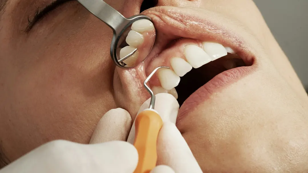 Dentist examining a patient's teeth with a mirror to check for sensitivity before recommending a whitening plan