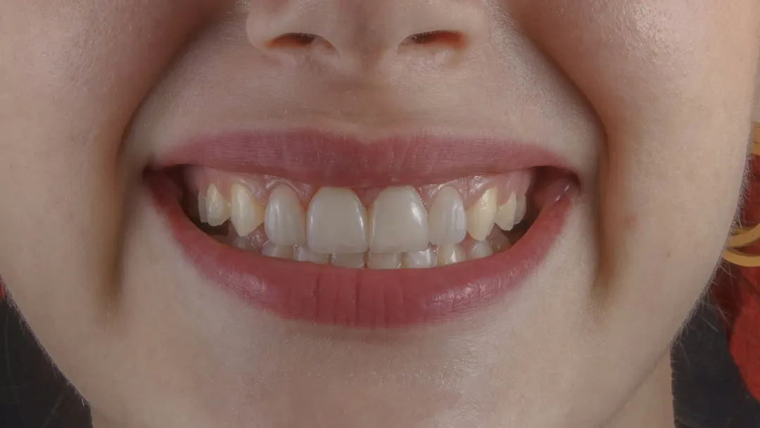 Close-up of a smile showing the gumline where gingivitis and periodontitis both begin