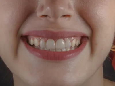 Close-up of a smile showing the tight contacts between teeth where floss reaches and a brush cannot