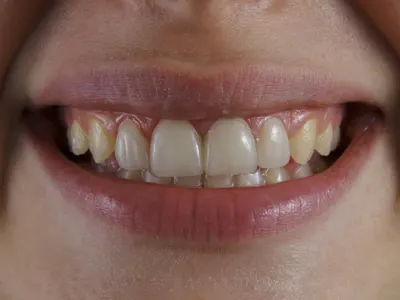 Close-up of a smile showing worn and chipped edges on the front teeth