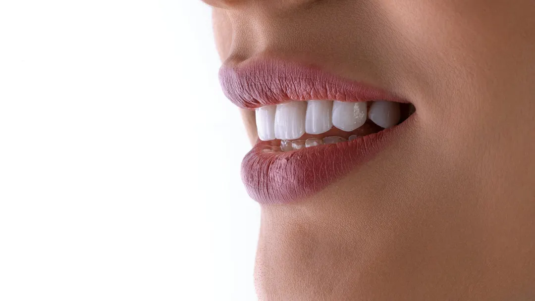 Close-up of a bright, white smile after professional teeth whitening