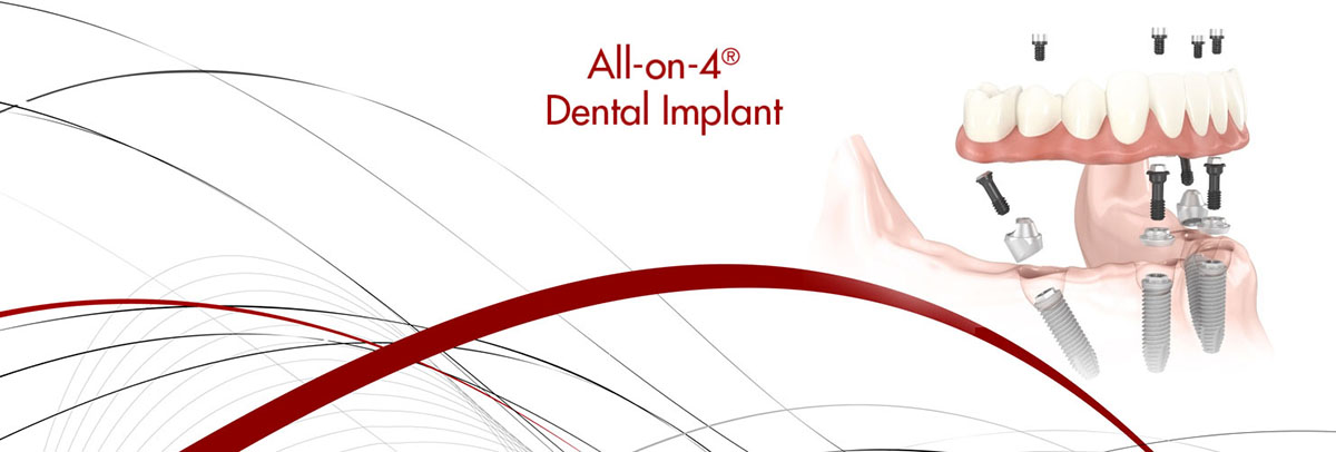 West Covina All-on-4 Dental Implants