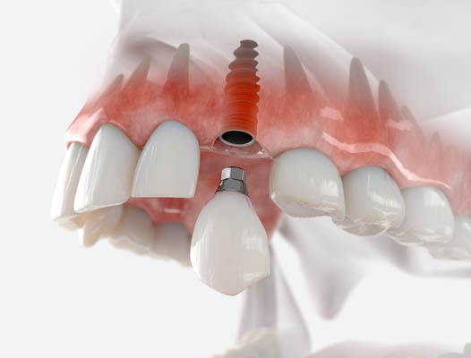 Dental Implant West Covina, CA