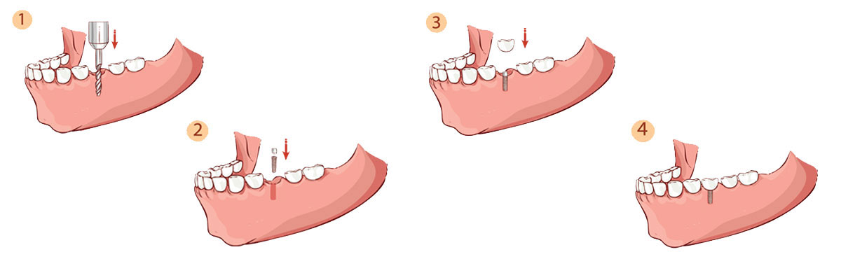 West Covina Dental Implant Restoration