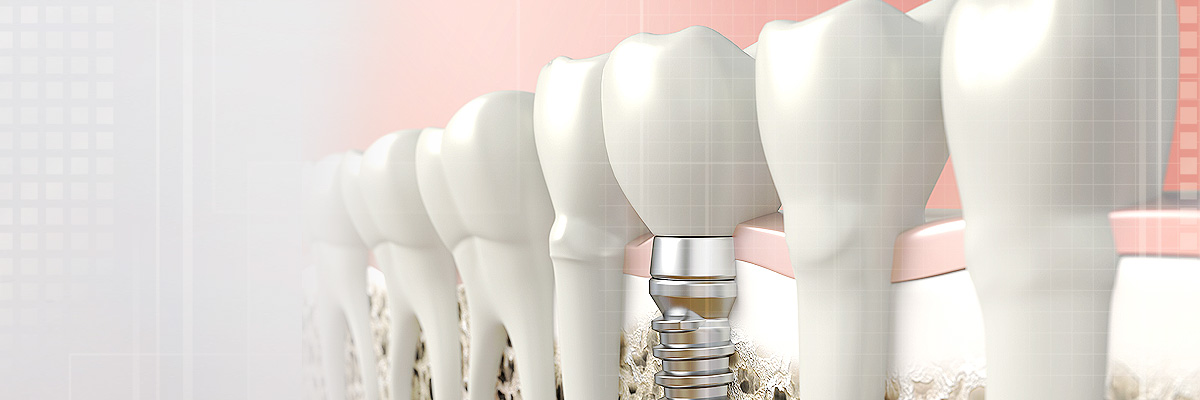 West Covina Implant Dentist