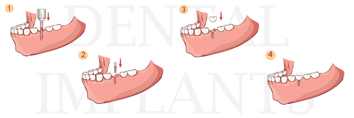 West Covina The Difference Between Dental Implants and Mini Dental Implants