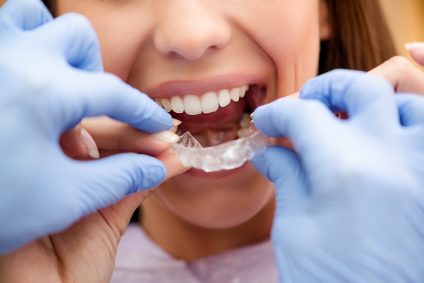 Questions For An Invisalign® Dentist In West Covina