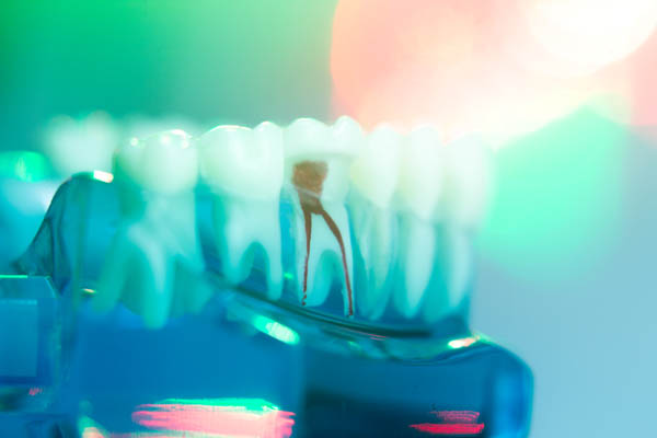 Do You Need A Crown After Root Canal Treatment?